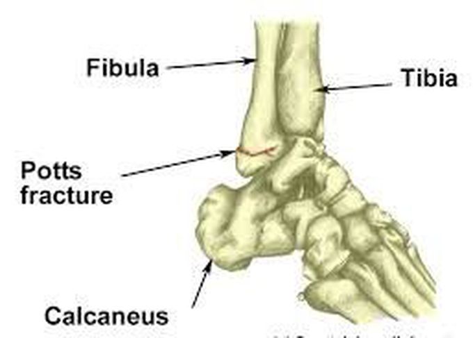 Potts fracture