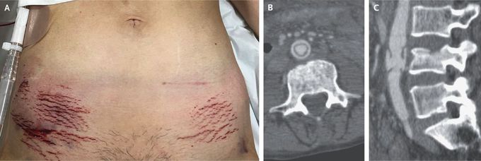 Seat-Belt Sign and Seat-Belt Aorta