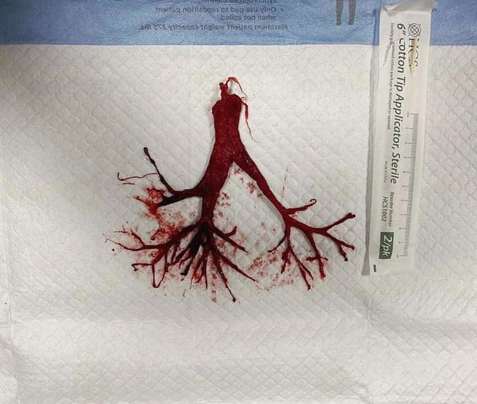 An intact blood clot that was attached to the ETT (endotracheal tube) of a terminally extubated Covid patient!