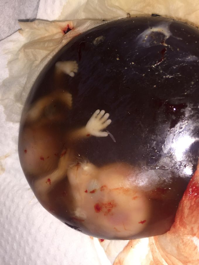 Missed abortion