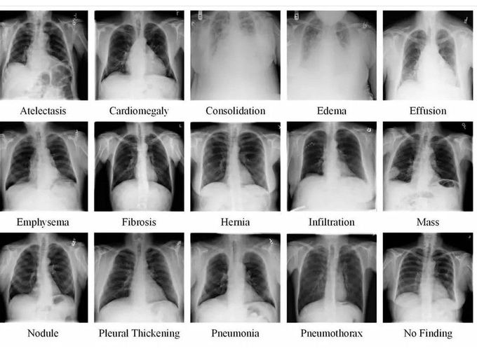 CXR Review