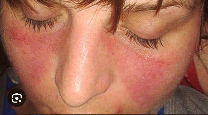 Systemic lupus erythmatosus