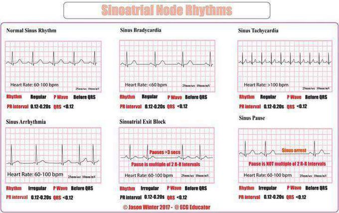 EKG