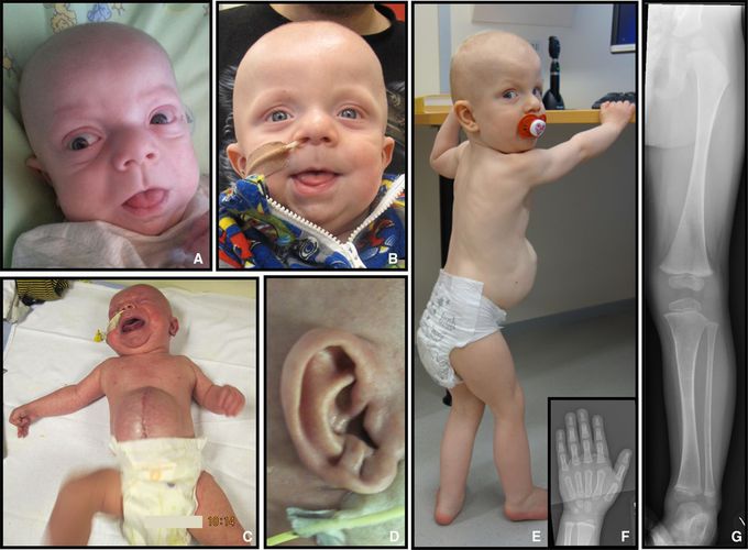 Beckwith-Wiedmann Syndrome