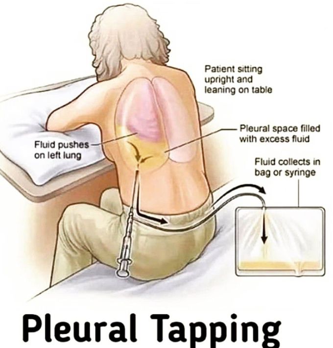 Pleural Tapping