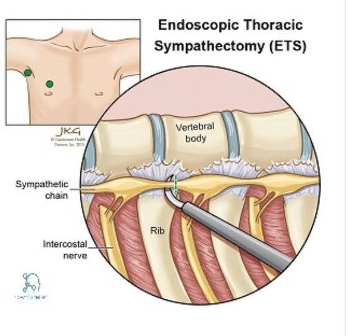 Sympathectomy