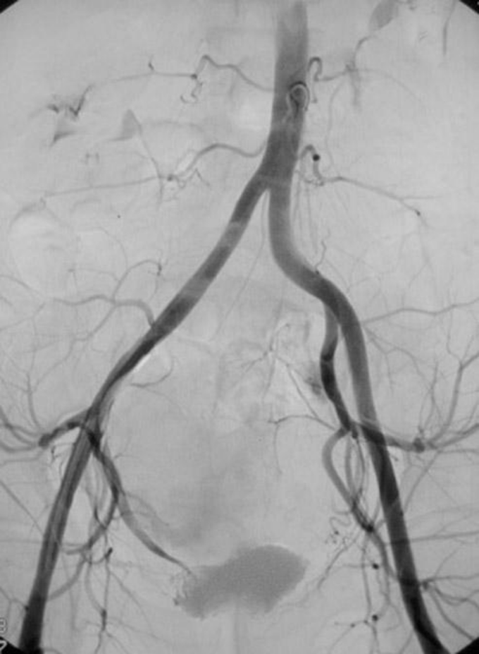 Post UFE Angiogram