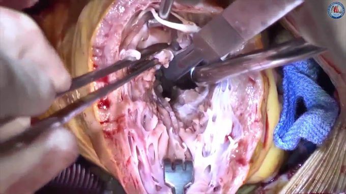 Myectomy in hypertrophic cardiomyopathy