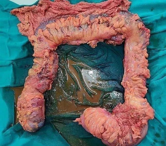 Total Colectomy