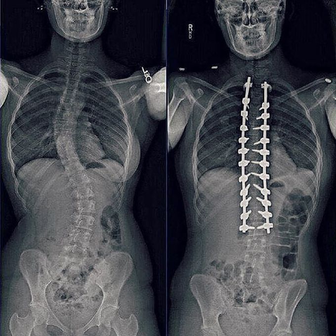 Preoperative (Before surgery) and Postoperative (After surgery) case of scoliosis