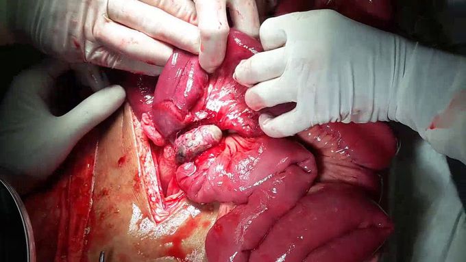 Strangulated Meckel's diverticulum causing intestinal obstruction