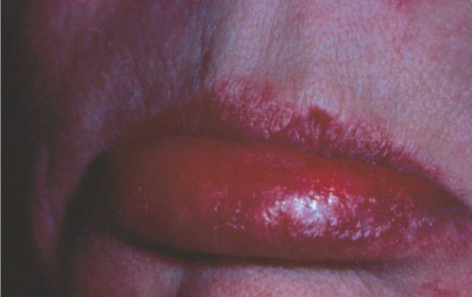 Lupus lesion