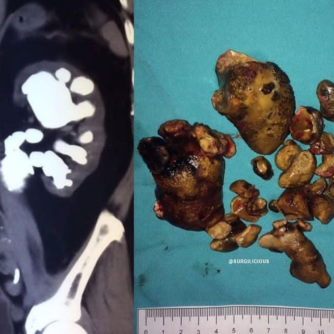 Kidney stones