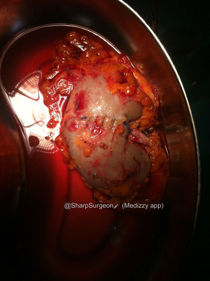 Kidney after tumor removal 👌🏻