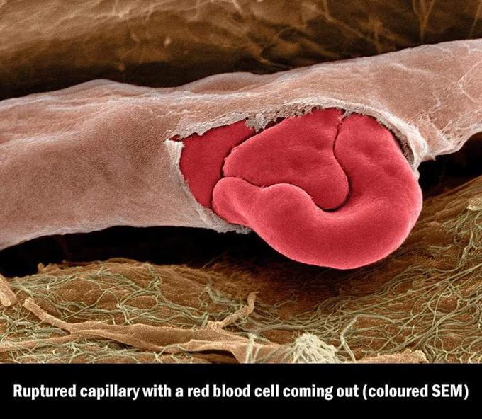 Ruptured capillary - MEDizzy