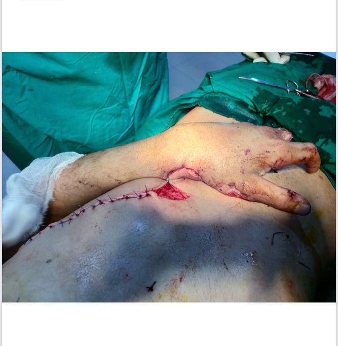 Abdominal Flap
