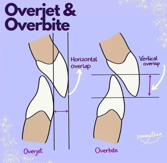 Overjet and overbite