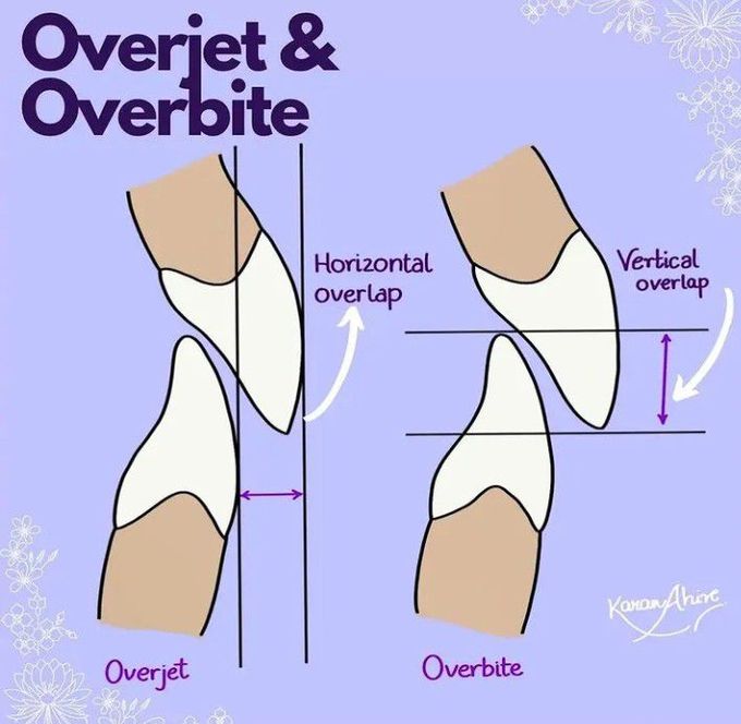 What is an overbite and what is an overjet? What is the difference?