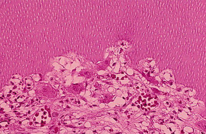 Internal resorption histopathology