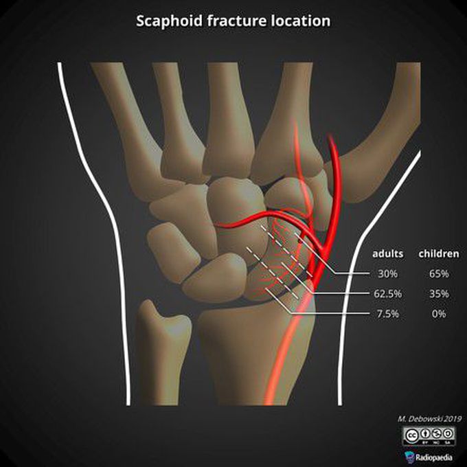 How are scaphoid fractures treated