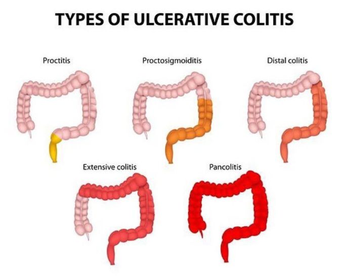 Ulcerative colitis