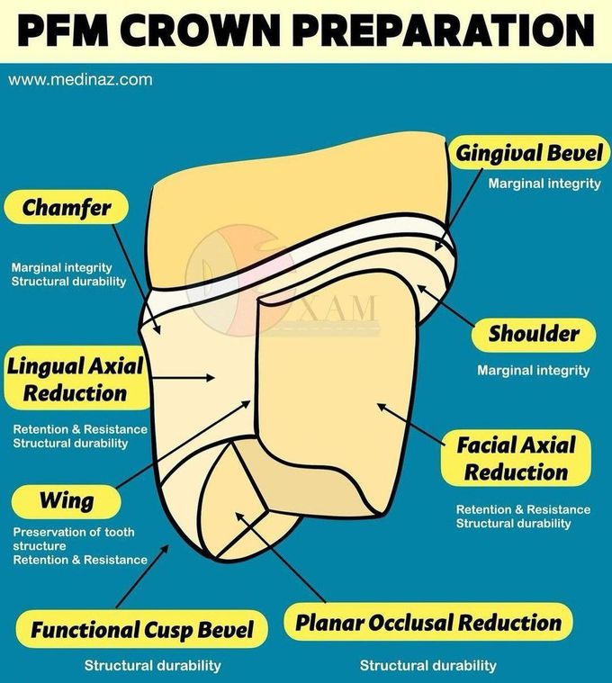 PFM Crown Preparation