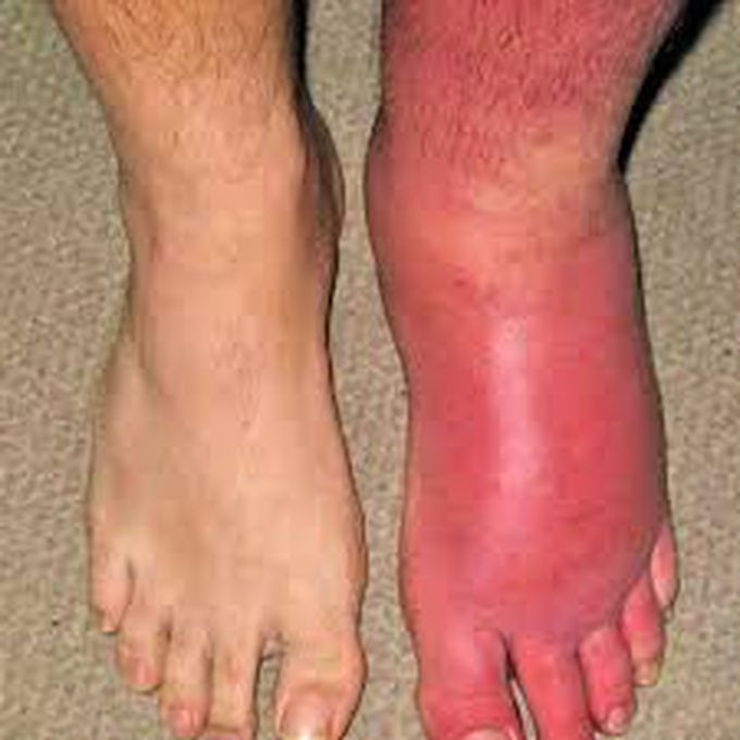 Cellulitis MEDizzy