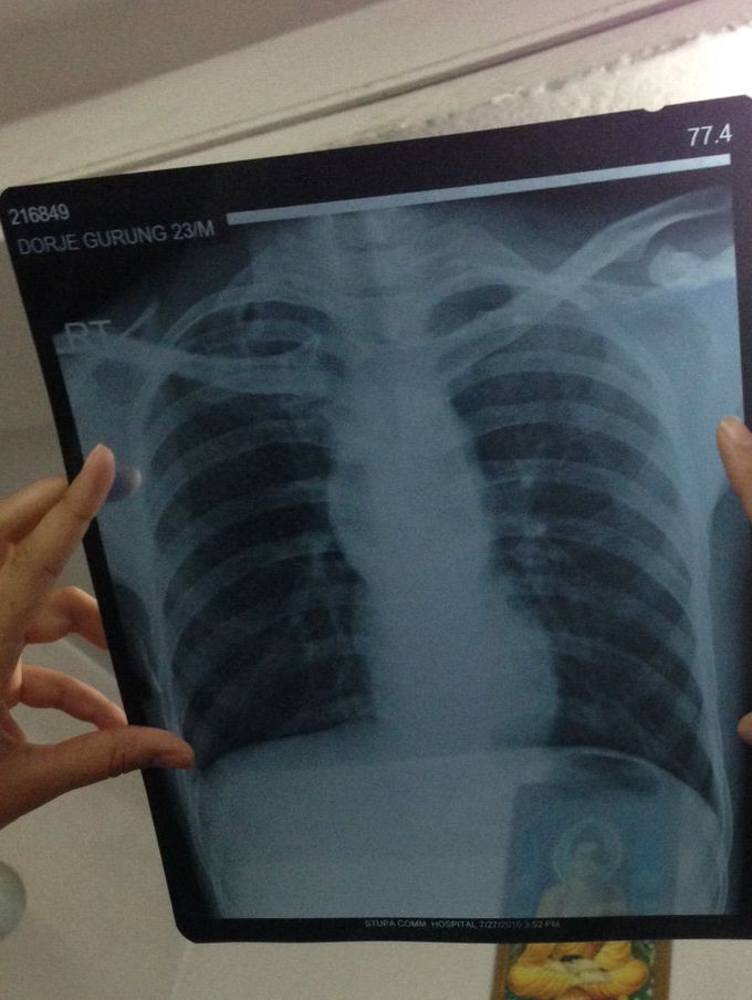 Chest X-ray