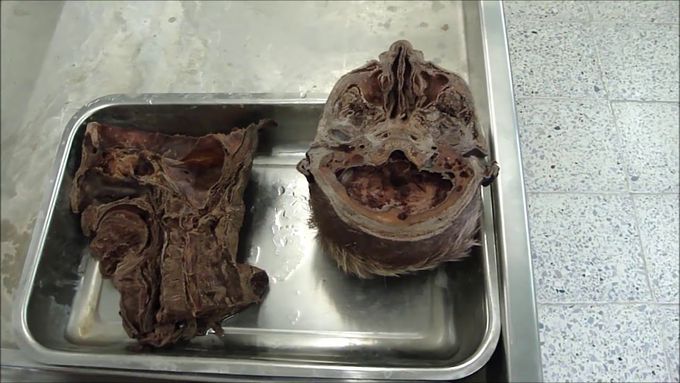 Anatomy of the nose and paranasal sinuses