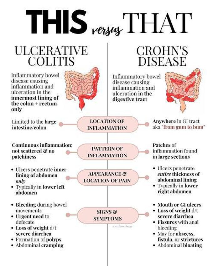 Ulcerative colitis vs Crohn's disease