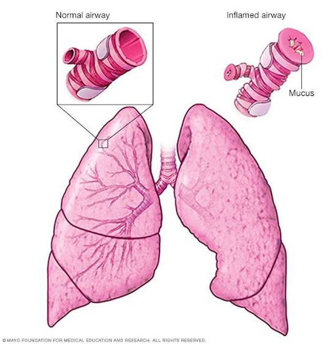 Causes of asthma