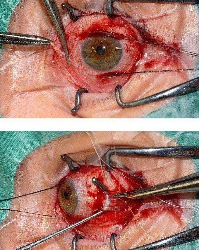 Strabismus