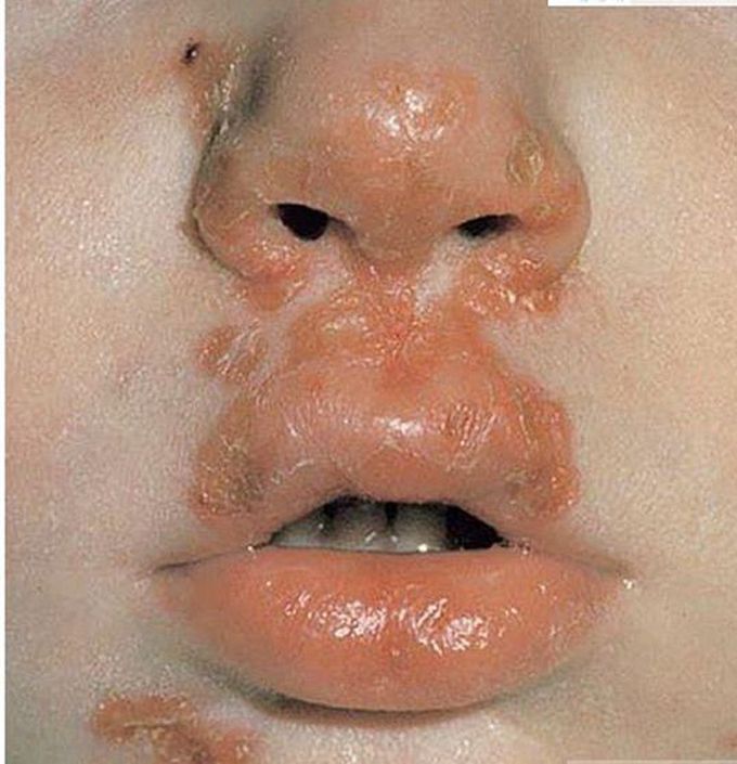 What is the Diagnosis and treatment?