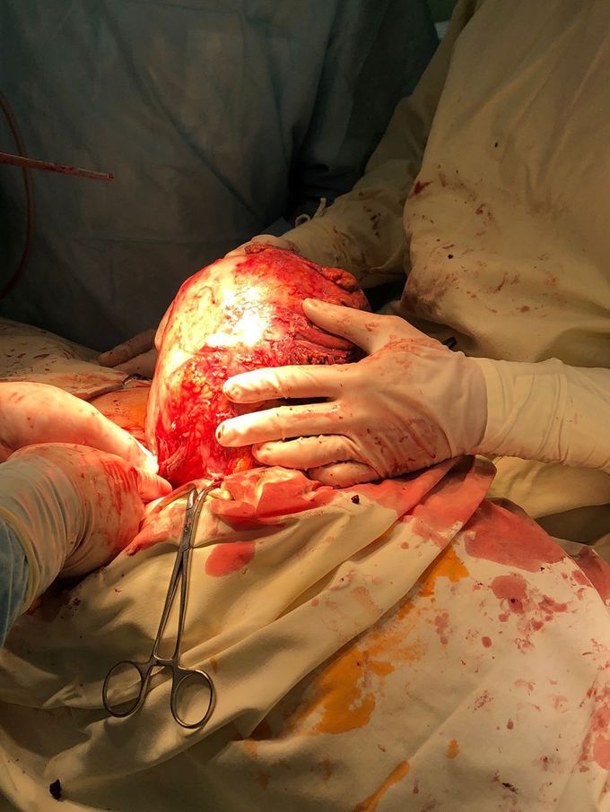 Removing of big size extraorgan tumor.