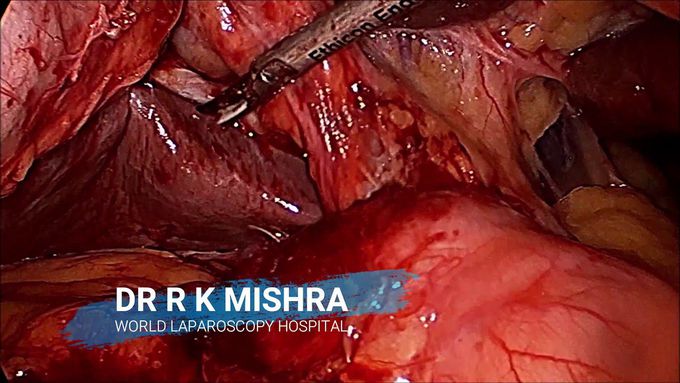Difficult Laparoscopic Cholecystectomy for Large Gallbladder Stone for Chronic Cholecystitis