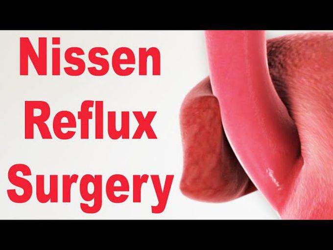 Nissen Fundoplication or Stomach Wrap Surgery to Treat Reflux - an animated video