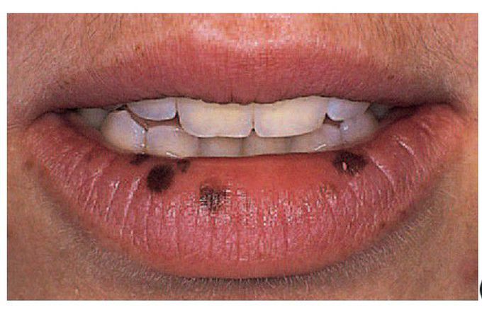 Melanocytic naevi.