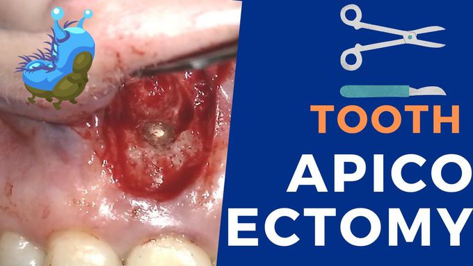 Apicoectomy- Step By Step