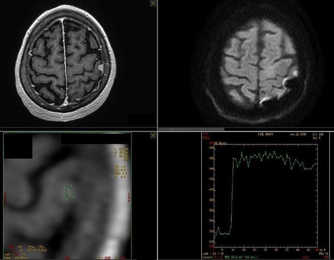 Multiparametric brain MR Imaging for meningioma evaluation
