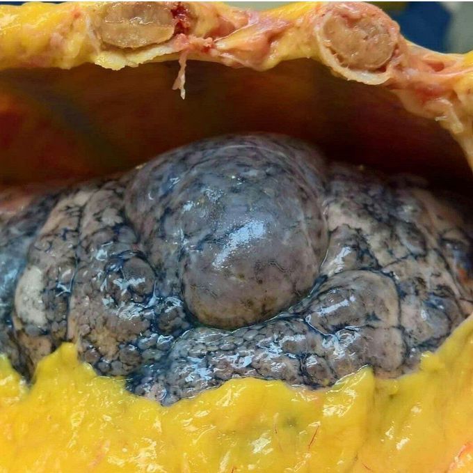 Pulmonary Emphysema (Smoker's Lung)