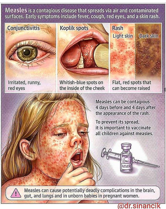 Measles