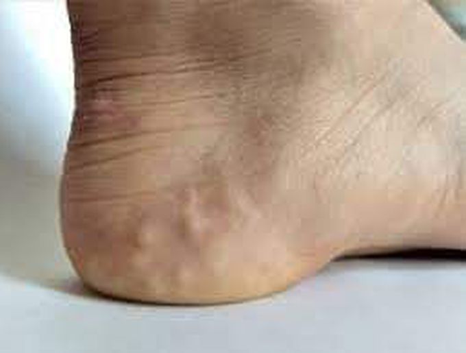 PIEZOGENIC PAPULES - World of medical notes