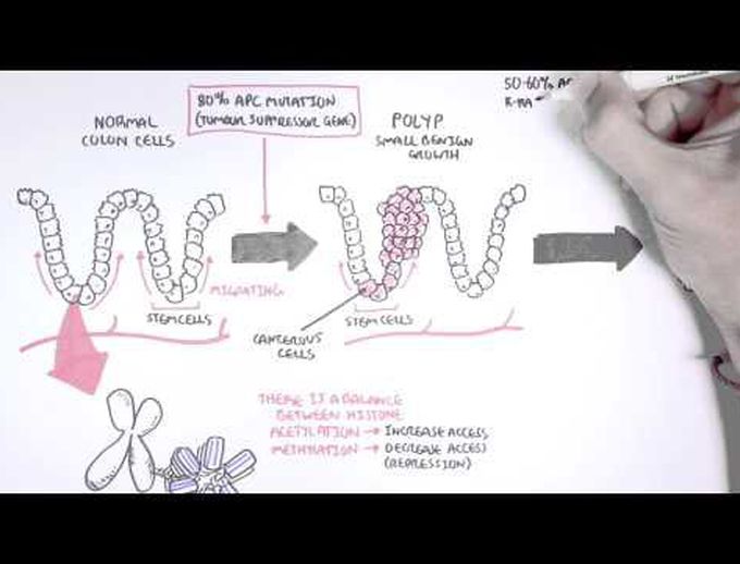 Colon Cancer Carcinogensis