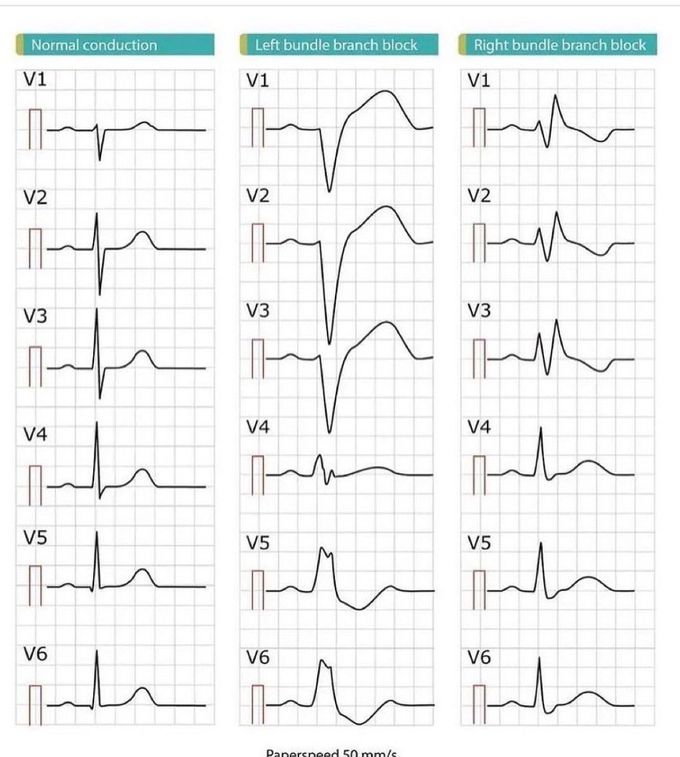 Types of Heart Block