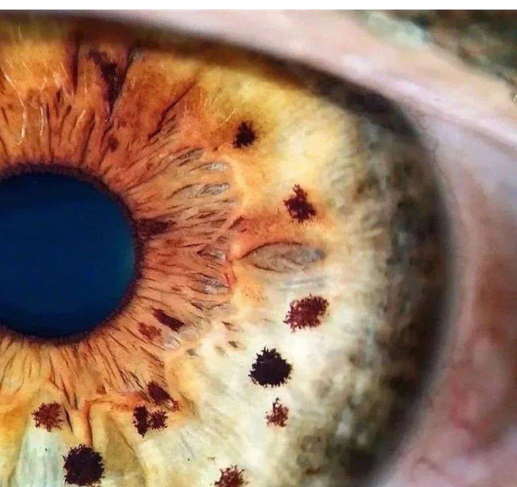 Esotropia - EyeWiki, image size:1030x970