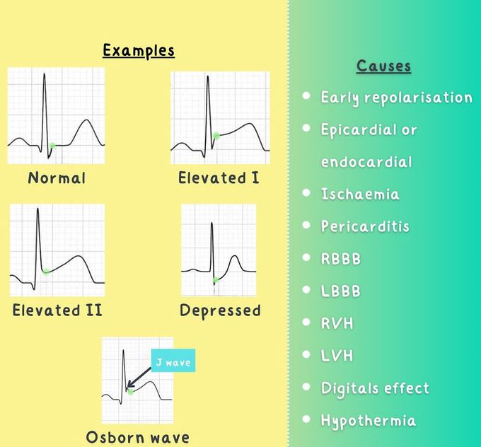 J Point on ECG II