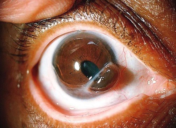 A corneal perforation with prolapsed iris! 