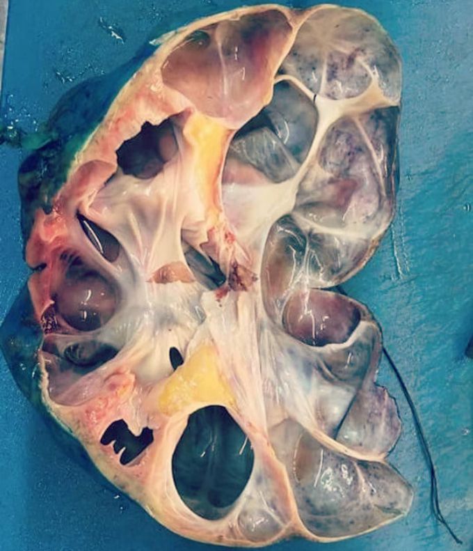 Polycystic kidney disease