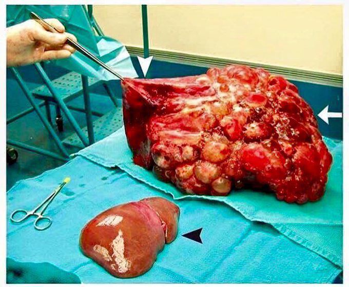 Normal Liver vs Polycystic Liver 