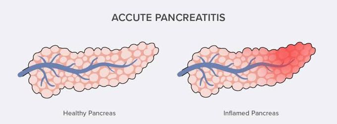 Acute Pancreatitis Overview